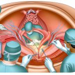 surgical procedure for MTF