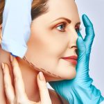 facial feminization surgery insights