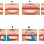precision in lip enhancement